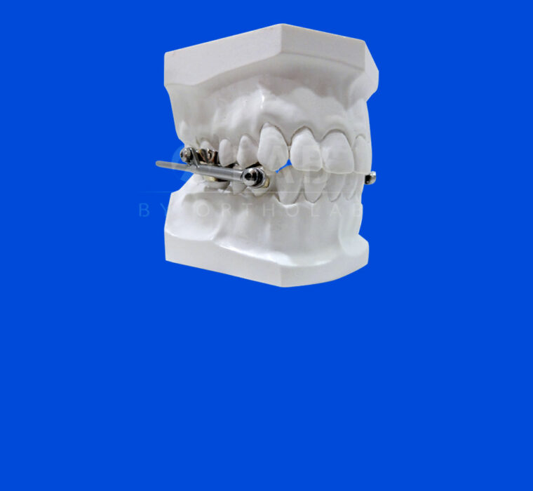 Activador Herbst - Aparatología Ortodoncia Funcional