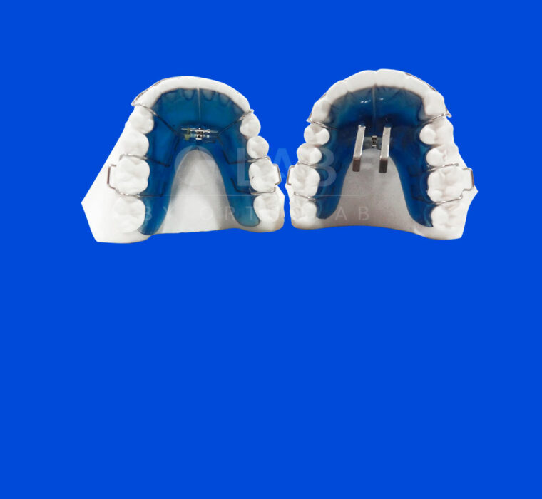 Placa Doble Sanders - Aparatología Ortodoncia Funcional
