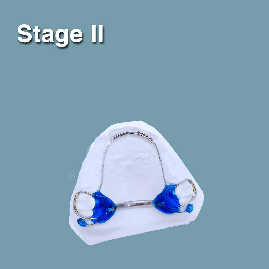 Stage II - Orthotropics aparatología de Ortodoncia